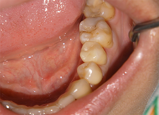 Gigi dengan karies kronik mungkin kelihatan seperti ini - pelbagai kesan kecil lesi dapat dilihat, biasanya tidak mengganggu orang tersebut.