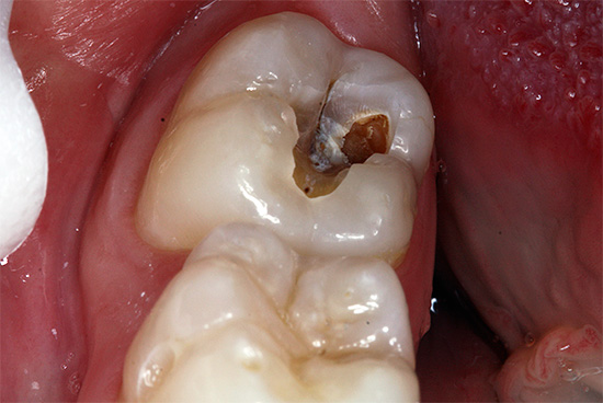 Aj pri hlbokom zubnom kaze, s chronickou formou vývoja, môže byť bolesť minimálna.