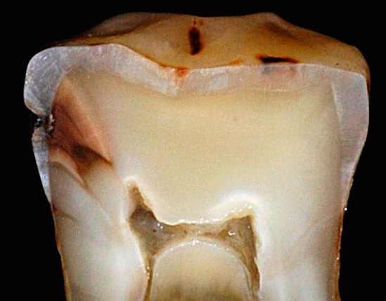 Dantų pjūvio nuotrauka rodo ėduonies įsiskverbimą į dentiną.
