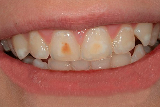 I focolai multipli della carie iniziale sono visibili sui denti: macchie bianche sullo smalto, a volte già pigmentate.