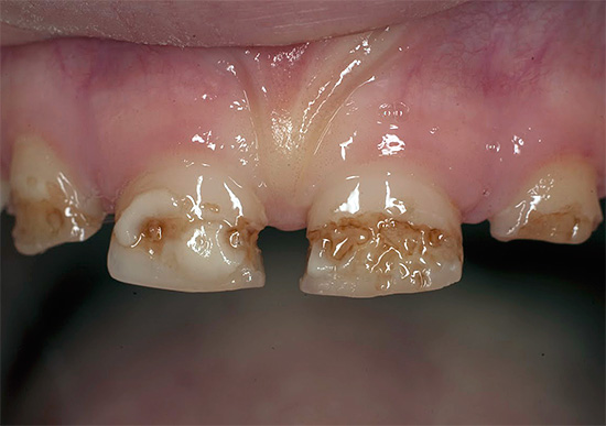 Tenk på de karakteristiske trekk ved den avanserte kariesformen, når nesten hver tann kan ha flere tegn på ødeleggelse ...