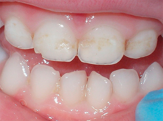 Ved de første tegnene på demineralisering av tannemaljen, må du kontakte tannlegen, og dermed forhindre at prosessen går i akutt form.