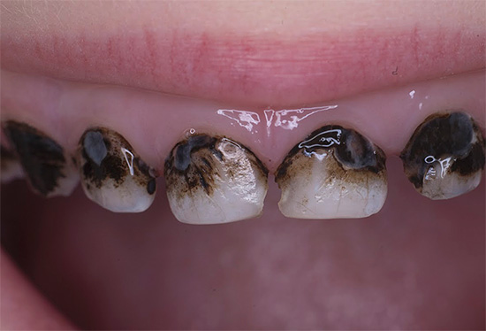 De foto toont een voorbeeld van verzilverde tanden (deze procedure bespaart echter niet altijd cariës)