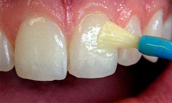 An effective method for the treatment and prevention of caries is the treatment of teeth with fluoride-containing preparations, for example, special varnishes.