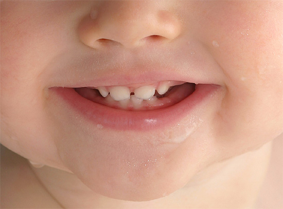 La prévention des caries devrait commencer immédiatement après l'éruption des premières dents chez un enfant.