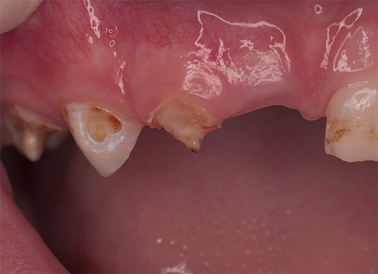 Uz generalizirani karijes, na gotovo svakom zubu postoje tragovi karioznih lezija.
