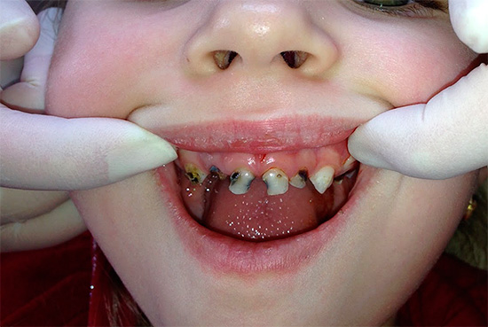 Todos los dientes en un niño están afectados por caries