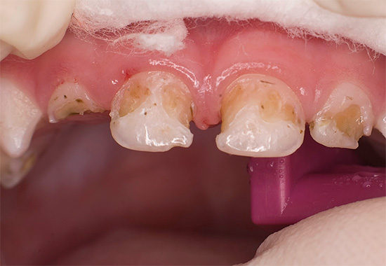 Avec la forme avancée de la maladie, une douleur intense peut être observée, et dans de nombreuses dents à la fois.