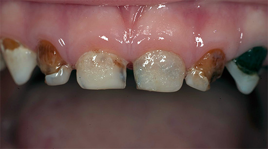 مثال على التسوس المعمم لأسنان الأطفال عند الطفل.