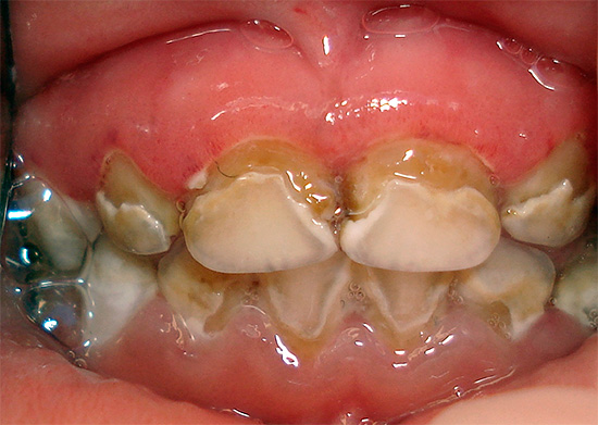 Decayed decay of deciduous teeth