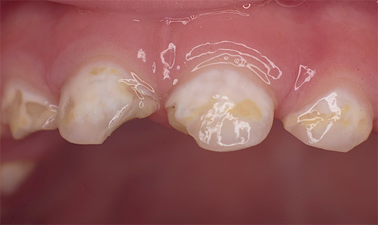 Roditelji trebaju pažljivo pratiti stanje zuba u djece, tako da na prve znakove karijesa započne liječenje i ne dopušta da proces uništavanja pređe u tako zanemaren oblik.