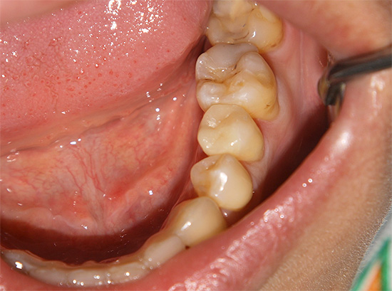 Výběr nejlepší varianty těstovin je do značné míry dán kariogenní situací v ústní dutině konkrétní osoby.