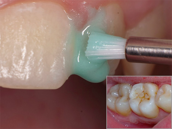 Kartais tikrai įmanoma išgydyti dantis, kurį paveikė ėduonis, bet šiuo klausimu yra keletas svarbių niuansų ...