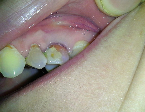 U pokušaju izliječenja propadanja zuba vodikovim peroksidom može se postići samo neravnomjerno mrlje zuba, a moguća je i opeklina oralne sluznice.