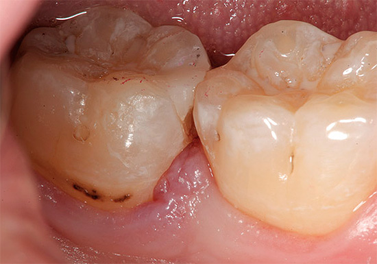 إذا كانت حالة الأسنان سيئة بشكل واضح ، فلا تؤخر الزيارة إلى طبيب الأسنان ، حيث لا يمكنك التخلص من المشكلة في المنزل.