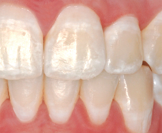 The photo shows an example of caries in the stage of the so-called white spot (sometimes it is also called chalky)