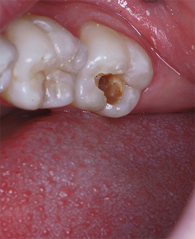 Dans la plupart des cas, lorsque vous essayez de gratter indépendamment les zones sombres de la dent, la cavité carieuse ne fera que s'approfondir et le risque de complications augmentera également ...