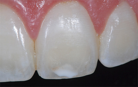 Im Stadium eines weißen Flecks ist es jedoch durchaus möglich, die Eigenschaften des Zahnschmelzes nicht nur beim Zahnarzt, sondern auch zu Hause wiederherzustellen.