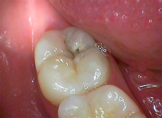 Selv ubetydelige mørke flekker på tyggeoverflaten på tannen (i sprekkområdet) er noen ganger et slags inngangshull i de dype karious hulrommene, som trenger inn i dentinlaget ...