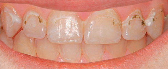 Malangnya, tidak ada jaminan bahawa melakukan rawatan itu sendiri, anda boleh membawa gigi kembali normal.