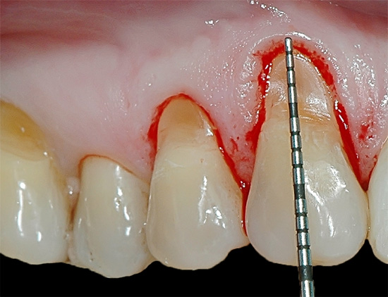 One of the problems in the treatment of cervical defects is getting blood from the gums into the working field.