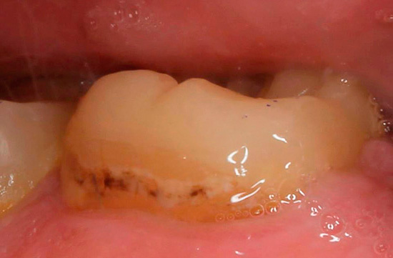 Izgleda kao zub s cervikalnim karijesom prije liječenja