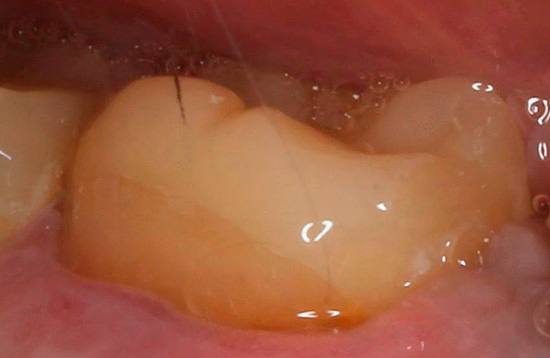 И същият зъб изглежда като след лечение, с вече инсталирана пломба.