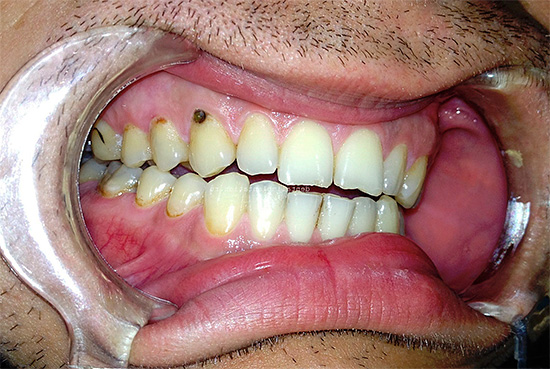 Fotografie ukazuje příklad cervikálního kazu na horním zubu