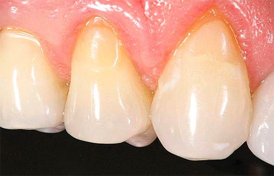Zuby po ošetrení krčka - zubný kaz - výplne sú ťažko viditeľné