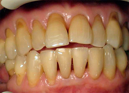 Sous la plaque dentaire, qui s'accumule dans une zone gingivale mal nettoyée, un processus carieux peut se produire activement.