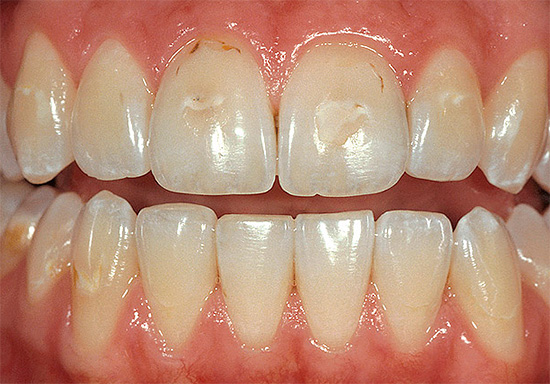 V počátečním stádiu vývoje může krční zubní kaz vést ke vzniku bílých skvrn, které se pak postupně pigmentují.