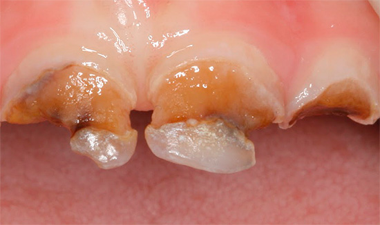Avec des caries circulaires profondes, une fracture de la couronne de la dent est possible