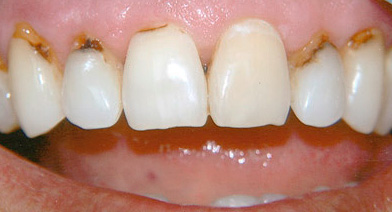 Any defects on the front teeth, not to mention cervical caries, greatly spoil the appearance of the smile zone.