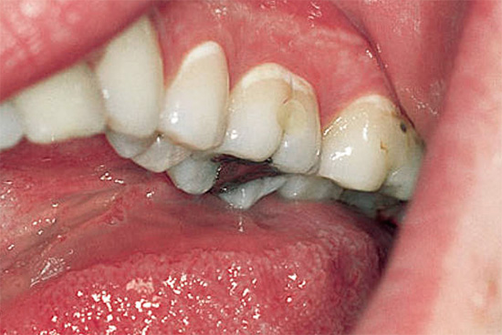 Fotografie ukazuje bílé oblasti demineralizované skloviny v cervikální oblasti několika zubů najednou.