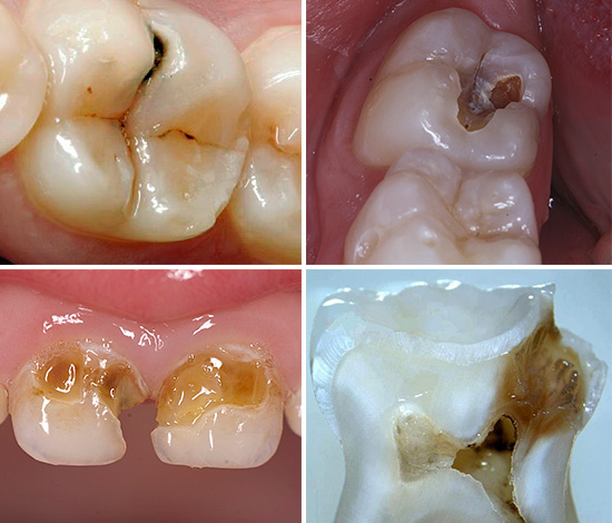 Vegem com pot aparèixer la càries diversa, a partir de les primeres etapes del seu desenvolupament i acabant amb greus lesions cariàries de diverses dents alhora.