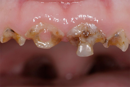 Generalized caries of deciduous teeth in a child.