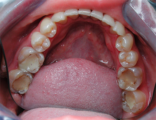 Кариесът може да се развие и под пломби, както и на места, където се вписват в околните тъкани на зъба.