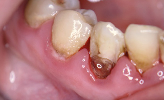 De foto toont een voorbeeld wanneer het cervicale gebied van de tand ernstig wordt aangetast door cariës.