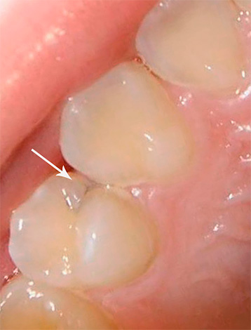 غالبًا ما يستمر تسوس الأسنان (التقريبي) في شكل كامن ، ولا يعطي أي شيء بصريًا.