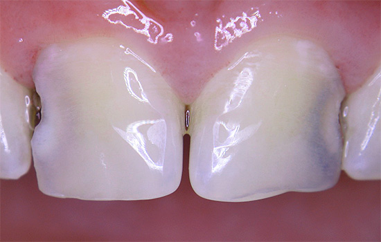 Wenn jedoch die kariöse Höhle zwischen den Zähnen wächst, wird das Problem schließlich mit bloßem Auge sichtbar.