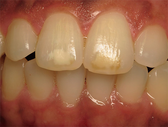 At an early stage of its development, caries leads to demineralization of enamel, as a result of which it sometimes becomes dull, whitens and begins to be pigmented by food colors.
