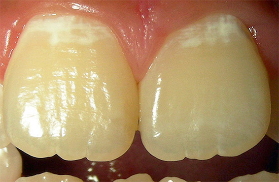 Lo stadio iniziale di lesioni cariose dei denti è anche chiamato stadio di una macchia bianca o di gesso.