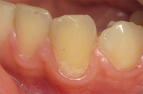 Снимката показва белезникава зона на деминерализиран емайл в цервикалната област на зъба.