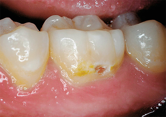 Et ici, la carie dans la région cervicale a presque atteint la dentine ...
