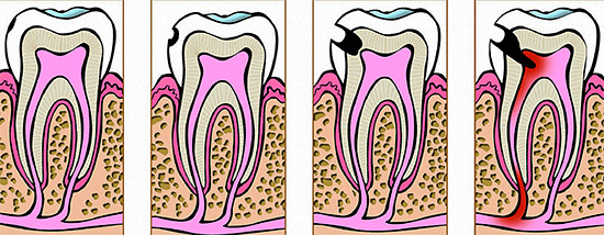 Stages of caries development: from the initial form to pulpitis.