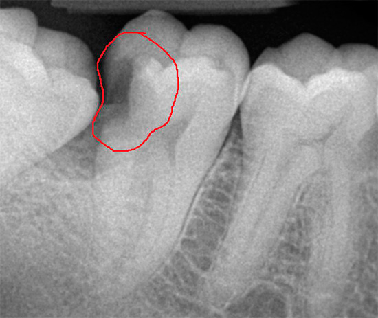 In this x-ray, a deep carious cavity is visible on the contact surface of the tooth.