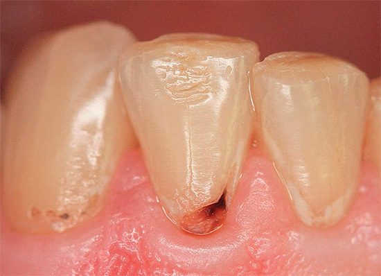 Un altro esempio di decadimento nel collo di un dente.