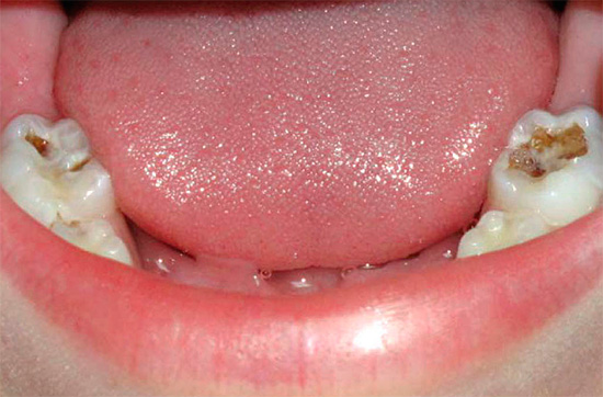 Med en så djup karies på tuggytor kan flisning av en försvagad tandvägg lätt uppstå, för att inte tala om den höga risken för pulpit.