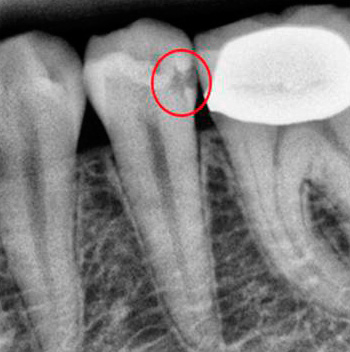 X-ray images help the doctor see those carious cavities that are not found during a routine visual examination.