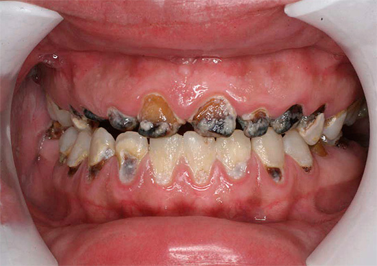 Cu carii generalizate, o distrugere destul de rapidă și severă a multor dinți în cavitatea bucală are loc simultan.